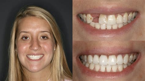 Madridge Journal of Dentistry and Oral. . Ivory smile veneers reviews
